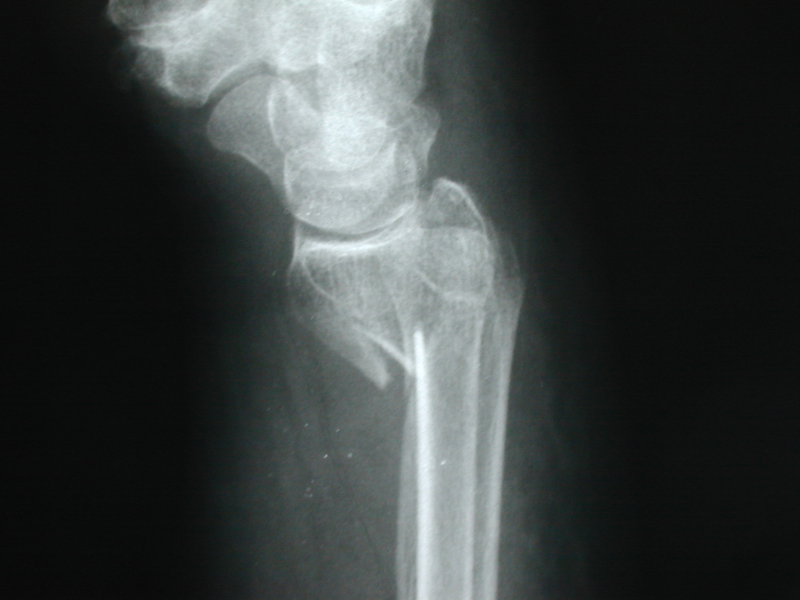 Unidad Cirugia de Mano y Reconstructiva La Plata-Argentina: Fractura de muñeca